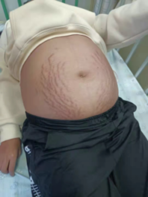 红牛策略 13岁女孩肚子隆起爬满“妊娠纹”，照完CT妈妈当场吓懵！